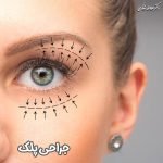جراحی پلک