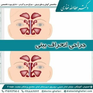 جراحی انحراف بینی
