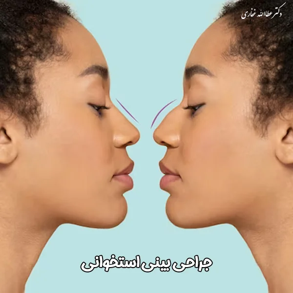 جراحی بینی استخوانی در تهران - دکتر عطاالله غفاری