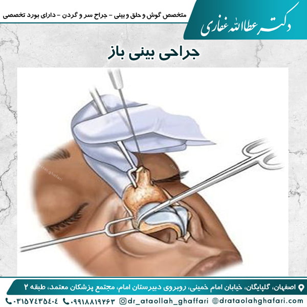 جراحی بینی باز