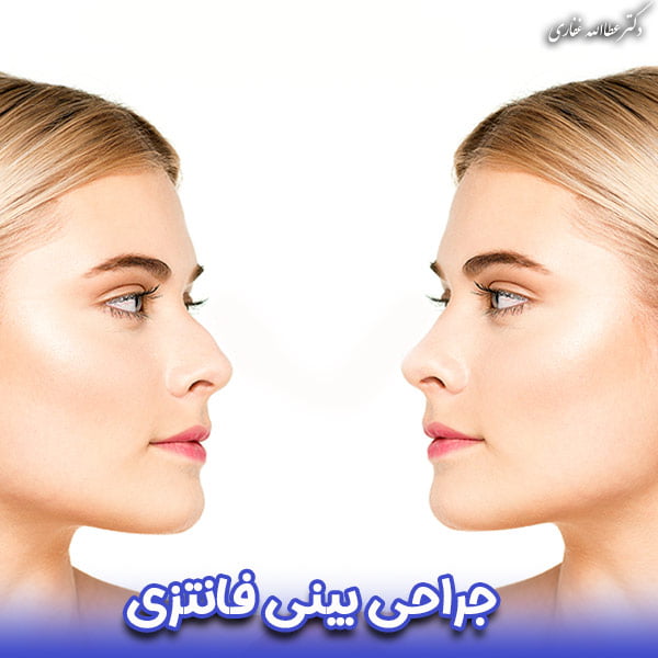 جراحی بینی فانتزی - دکتر غفاری